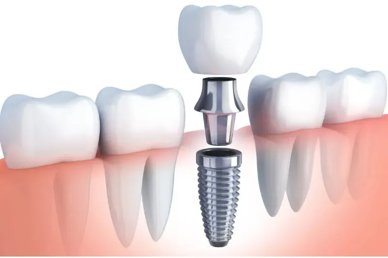 Dental Implants, Crowns & Bridges