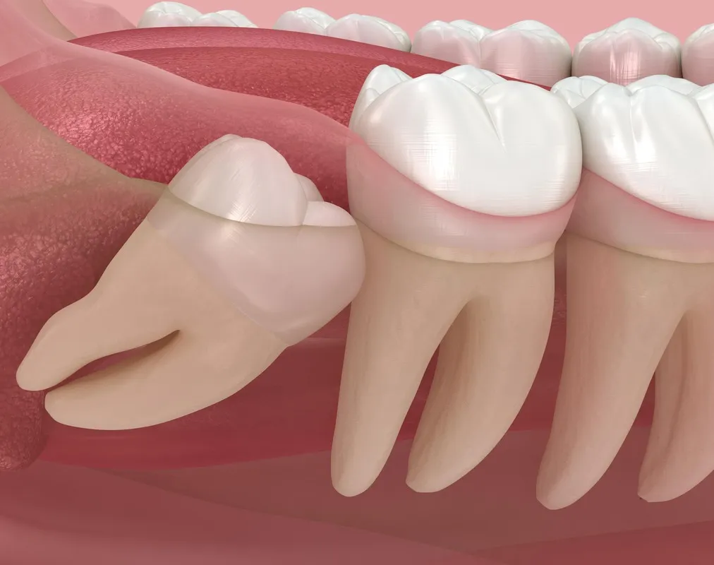 Wisdom Tooth Removal/IIIrd Molar